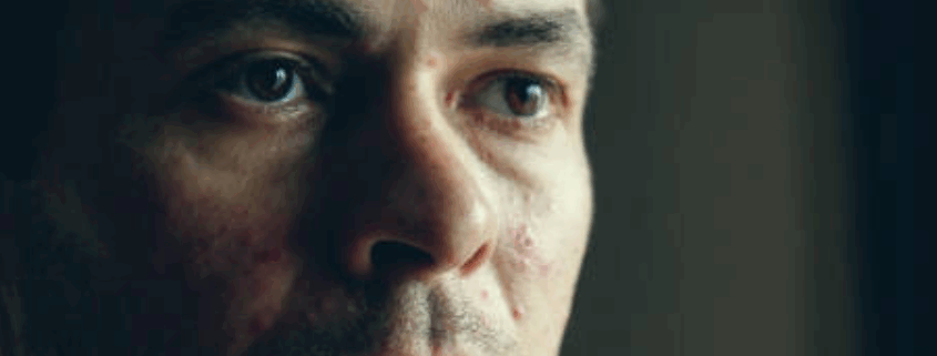A gay person having prominent meth skin sores on their face.