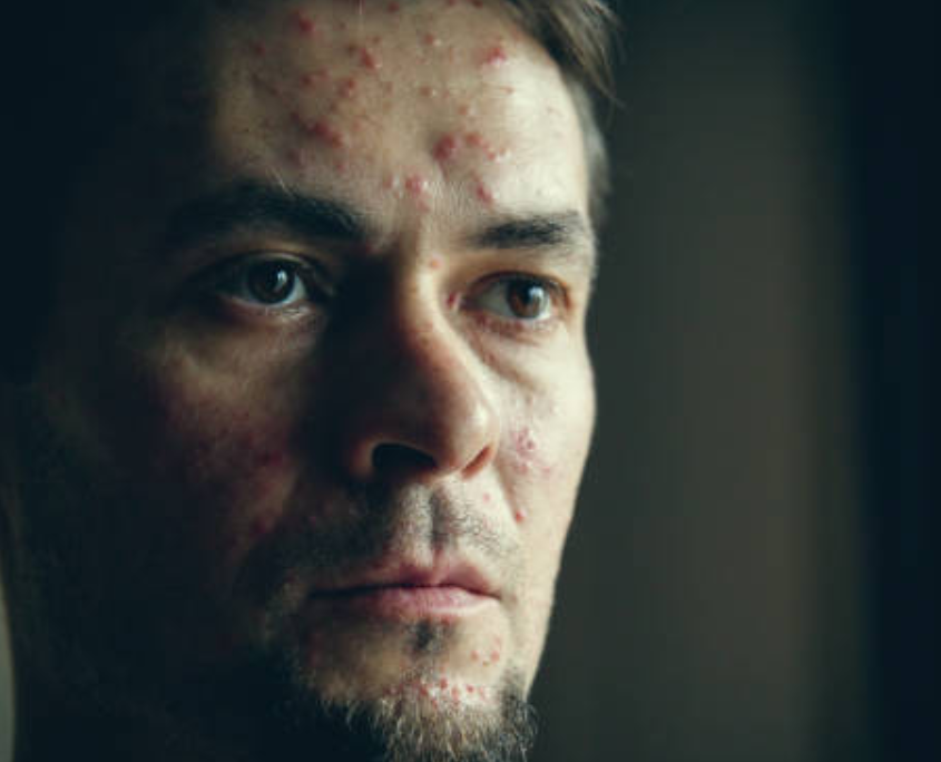 A gay person having prominent meth skin sores on their face.